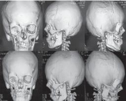 Silva RAG et al. RESULTADOS Em nenhum dos pacientes houve rejeição do enxerto ósseo.