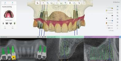 Obtenha mais casos de restauração com implantes ao oferecer guias cirúrgicos O software do 3Shape Implant Studio torna fácil
