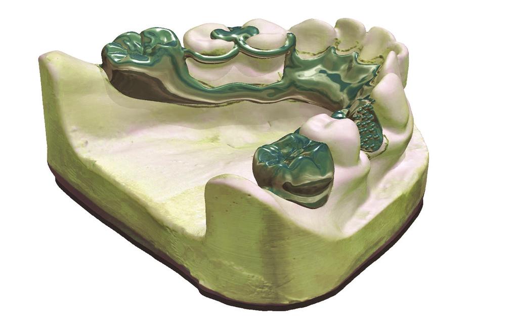 O projeto de Próteses Parciais Removíveis se inicia com os dentes virtuais Melhorias revolucionárias na impressão em 3D estão fazendo a produção digital de PPR mais rentável para os laboratórios.