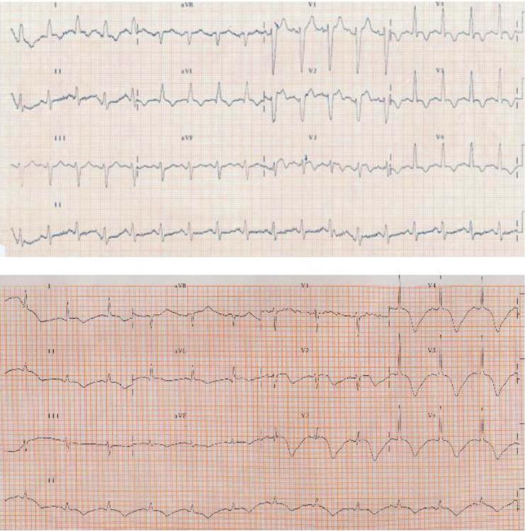 Fig. 1 - Eletrocardiogramas de 12 derivações traçados no momento da admissão na sala de emergência (painel superior) e 24 horas após (painel inferior).