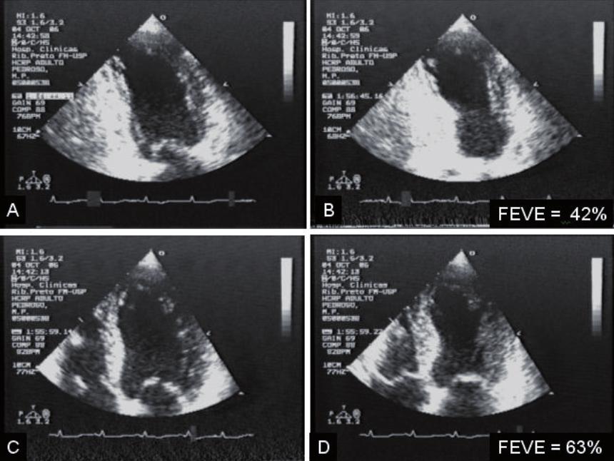 Fig. 3 - Imagens ilustrativas dos exames ecocardiográficos transtorácicos obtidos no quarto dia de evolução clínica (A e B) e antes da alta hospitalar, três semanas após (C e D).