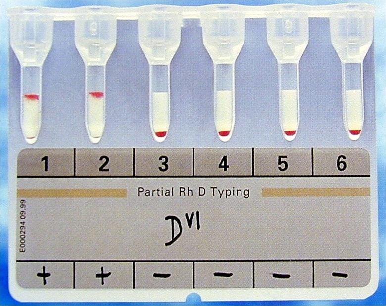 00 ANTICORPOS Rh Anti-D : uma vez formado persiste por muitos ANTICORPOS Rh Clinicamente significativos anos, pois o antígeno D é altamente Envolvidos em reações transfusionais