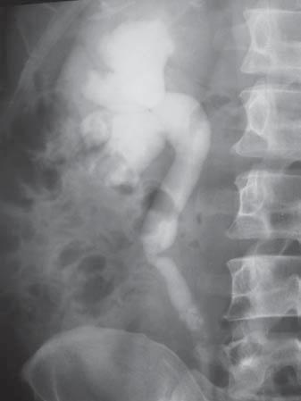 Análise retrospectiva das urografias excretoras em um serviço de radiologia de um hospital geral Figura 5. Falha de enchimento no terço médio do ureter direito. Figura 6.