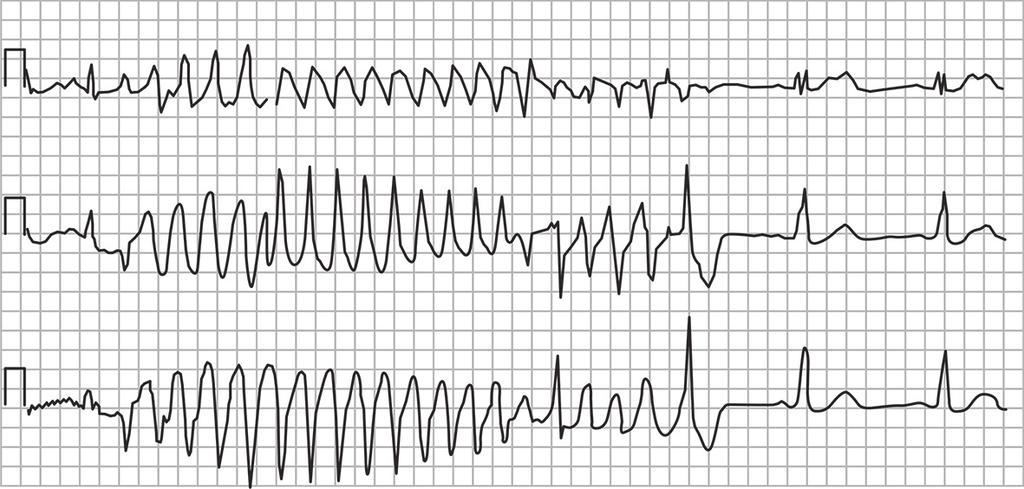 14 Por isso, tais pacientes possuem indicação de Classe I para colocação do CDI. 17 Figura 10 Taquicardia ventricular monomórfica sustentada. Fonte: http://www.lookfordiagnosis.