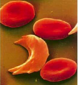 Anemia falciforme e hemoglobina S (HbS) A HbS apresenta um resíduo de valina na posição 6 da cadeia b, no lugar do ácido glutâmico presente na