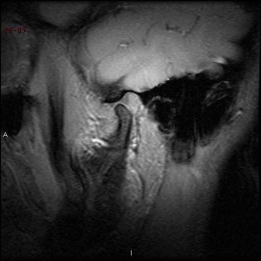 Rao e El-Noueam (1998) 13 estudaram diversas doenças inflamatórias dos seios paranasais através de tomografias computadorizadas que permitiram a avaliação adequada do complexo osteomeatal