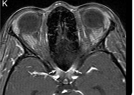 NEURITE OPTICA