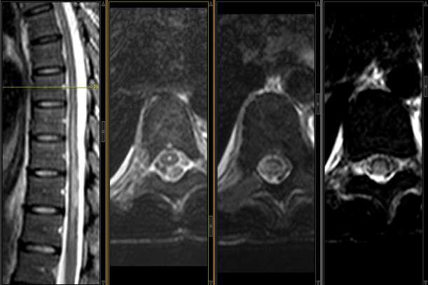 Lesão medular extensa