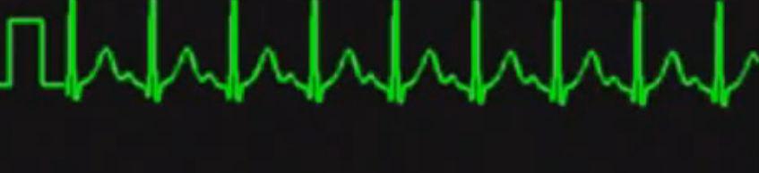 Frequência Atrial e Ventricular alta Está