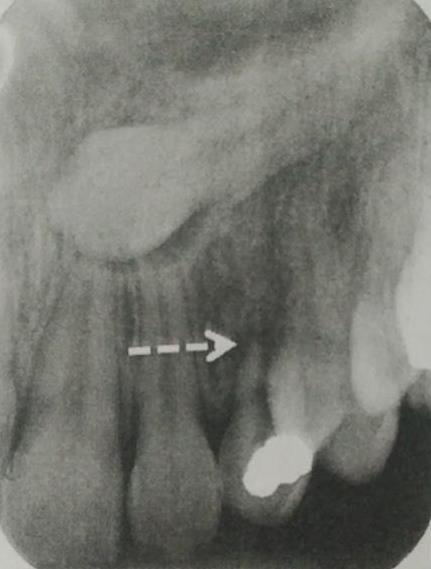Figura 5 Radiografia periapical - Permite observar a presença de uma lesão periapical no canino decíduo e desvio do canino permanente. (adaptado de Becker e Chaushu, 2015) c.