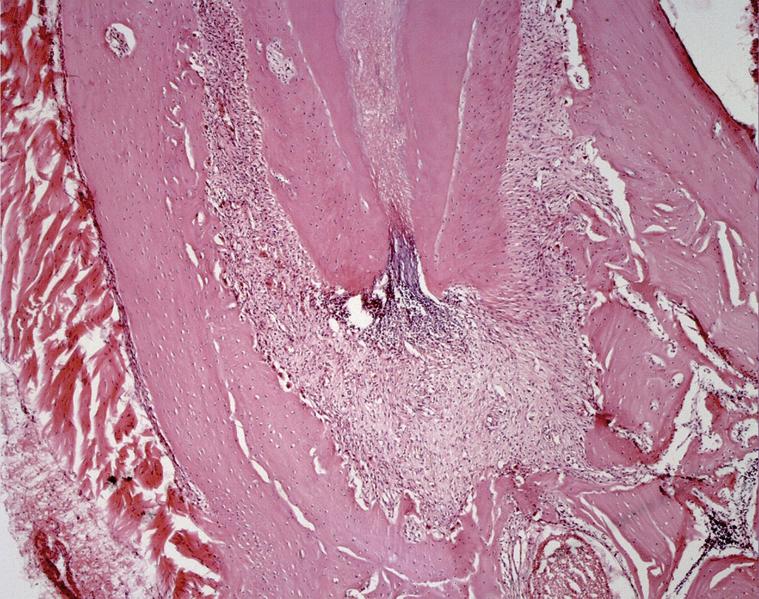 Área periapical com intensa proliferação vascular FIGURA 1.2 Corte histológico mostrando a inflamação no ligamento periodontal apical com intensa proliferação vascular e aumento do espaço periodontal.