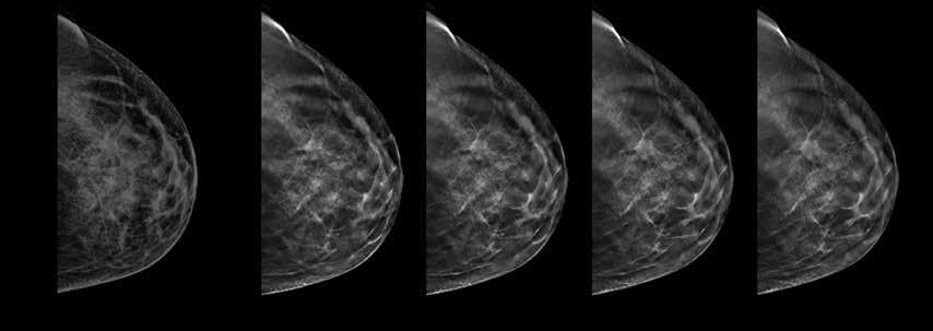 Simplesmente uma melhor mamografia O exame de mamografia 3D a partir do Sistema Selenia Dimensions ajuda a encontrar cânceres invasivos anteriormente, e reduzir recalls desnecessários.
