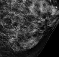Nossa baixa dose para exames de mamografia 3D é alimentada por um software C-View, que gera imagens em 2D a partir de dados tomossíntese sem exposições adicionais 2D em 3,7 segundos de
