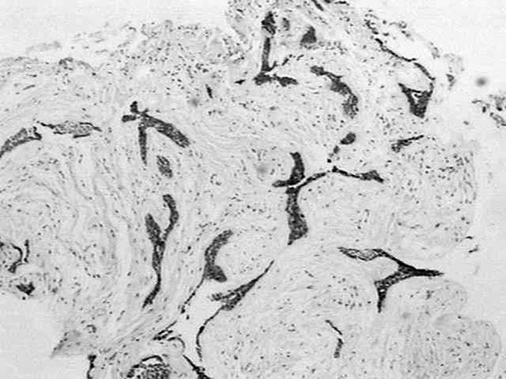 Colágeno I Semelhante à fibronectina, toda a extensão do estroma tumoral da lesão híbrida do ameloblastoma desmoplásico exibiu, também, uma forte imunomarcação para esta proteína da MEC, em padrão