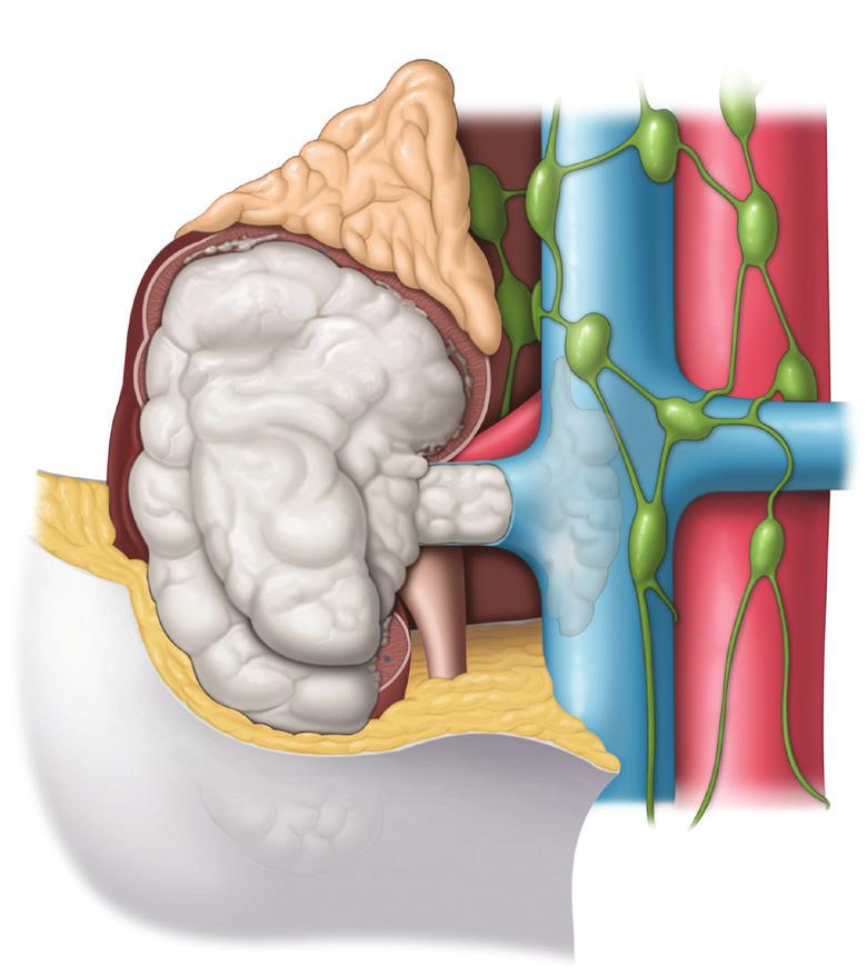 3: Os tumores de estádio espalharam-se para a veia renal, para o tecido adiposo junto ao rim (gordura perirrenal) ou
