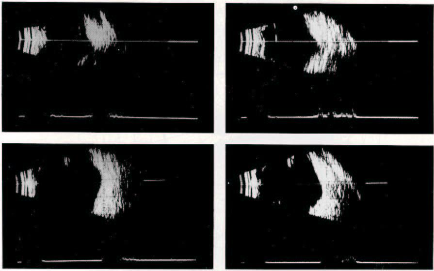 Figura 8 Figura 8-Ecogramas B de ambos os olhos das duas ultimas observações: