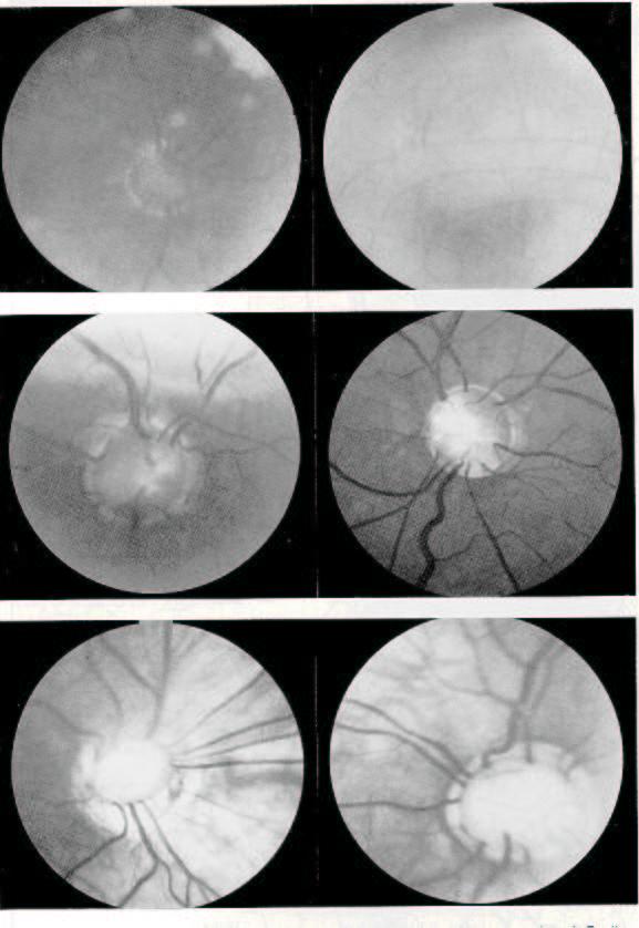 Figura 5 Figura 5-Fotos das papilas de ambos os olhos de três pacientes de gerações consecutivas de Papila em Campainha (avô, pai e filho).