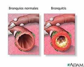 Bronquite Crônica (Inflamação dos Brônquios) Enfisema Pulmonar (Destruição alveolar) Tosse Expectoração Infecções Freqüentes