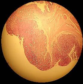 Carcinoma de Bexiga organizada, mitose e atipias celulares. Dermatite Aguda Coágulo sanguíneo e infiltrado inflamatório.
