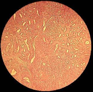 Fibrose Pulmonar Tricromo de Masson Tecido cicatricial, com coloração seletiva ao tecido fibroso.