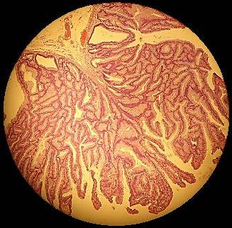 Pólipo Intestinal Elevações no plano da mucosa. Pielonefrite Pancreatite Aguda Infiltrado inflamatório.