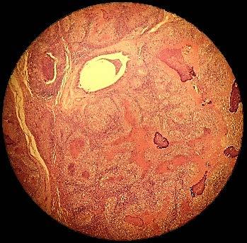 Trombo em Organização Tuberculose Pulmonar Massa de fibrina e células da parede do vaso. Granulomas.