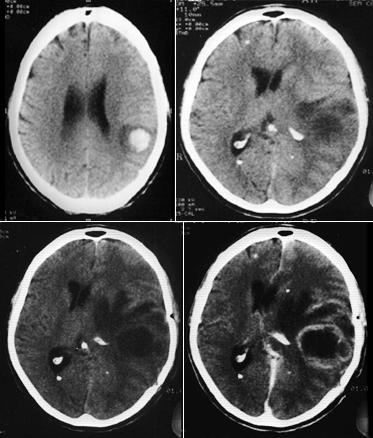 202 Principais causas de hemorragia cerebral em adultos: HAS...60% MAV...29% Aneurismas...10% Angiopatia amilóide...10% Neoplasias...10% Drogas.