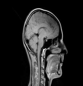 t/ml 63 Fisiopatologia da BH Controlo