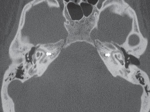 em que a janela oval é preenchida pela lesão otosclerótica em proporções variadas e o ligamento anular fica totalmente comprometido, impossibilitando, assim, a delineação das margens da fenestra