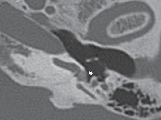 Figura 11. Corte tomográfico em axial. Obliteração da janela redonda (seta). Figura 12. Corte tomográfico em axial. Aquedutos vestibulares dilatados (setas). Figura 13.