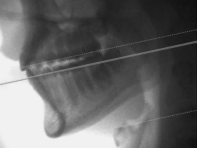 Um novo método para avaliar as inclinações dentárias utilizando a tomografia computadorizada gerados pela movimentação dentária de corpo (translação) 9.