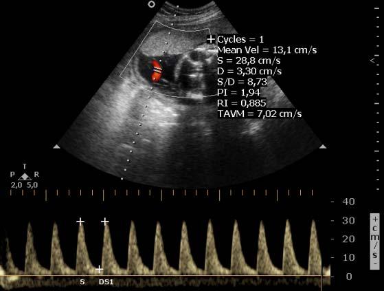 Métodos 47 4.3.2.1. Artéria umbilical A dopplervelocimetria da AU foi realizada pela insonação do cordão umbilical próximo ao local de sua inserção na placenta.