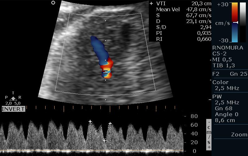 Métodos 49 4.3.2.3. Ducto venoso A análise do DV foi efetuada em corte ultrassonográfico transverso do abdome fetal, na altura da inserção do cordão umbilical.