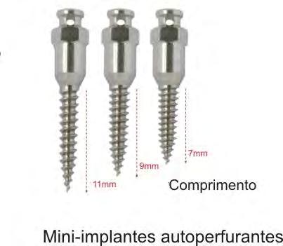 56 Figura 1 - Mini-implantes de 7, 9 e 11mm de