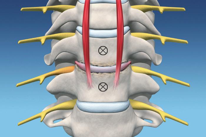 Abordagem Utilizando uma técnica de abordagem cervical padrão pela direita ou pela esquerda, disseque até ao(s) nível(is) de tratamento e confirme o espaço intervertebral desejado com fluoroscopia.