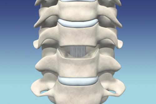 Preparação da placa terminal vertebral Utilize goivas, furadores e/ou brocas para remover os osteófitos anteriores e posteriores.