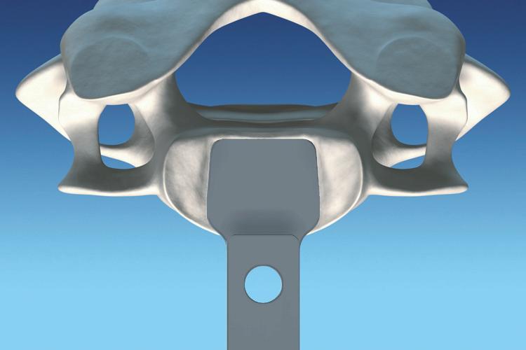 Medição do comprimento Com orientação e visualização fluoroscópica, utilize o teste para determinar o tamanho correto (médio, médio longo, grande, grande longo) do disco cervical artificial M6-C.