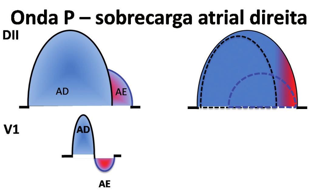 ABC DO ECG Figura 2 - Aumento do componete atrial direito com
