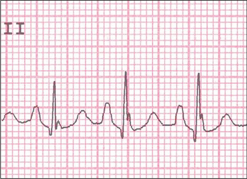 (V1) Figura 3 A - Eletrocardiograma demonstrando a sobrecarga