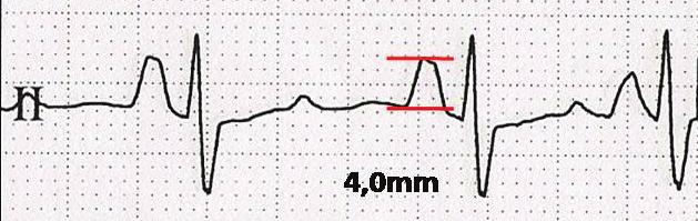 amplitude Figura 3 B - Eletrocardiograma demonstrando a