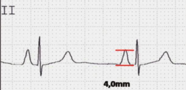 a sobrecarga  amplitude 44