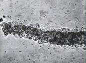 Tipo Origem Significado clínico Hialino Hemático Leucocitário Bacterianos Secreção tubular de proteína de Tamm- Horsfall que se agrega as fibrilas Hemácias emaranhadas ou ligadas à matriz das