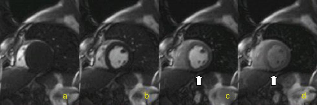 Ressonância magnética cardíaca de perfusão em stress: a experiência de um centro nacional 3 Figura 1 Sequência IR-SSFP imagem no eixo curto. (a-d) Defeito de perfusão da parede inferior (seta).