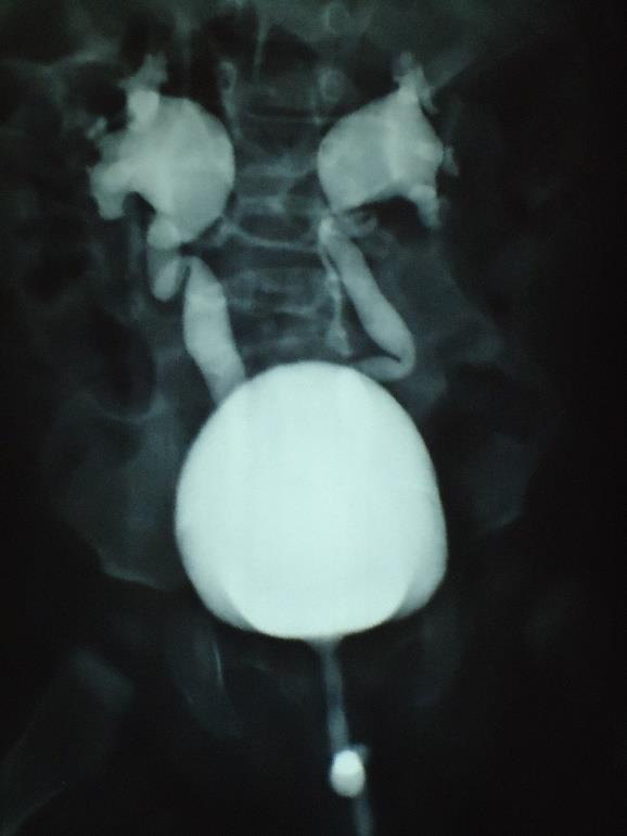 11 FIGURA 4: REFLUXO VESICOURETERAL (RVU) BILATERAL. Urografia excretora (UE) Atualmente é utilizada só em situações especiais como no pré-operatório de patologias do trato urinário.