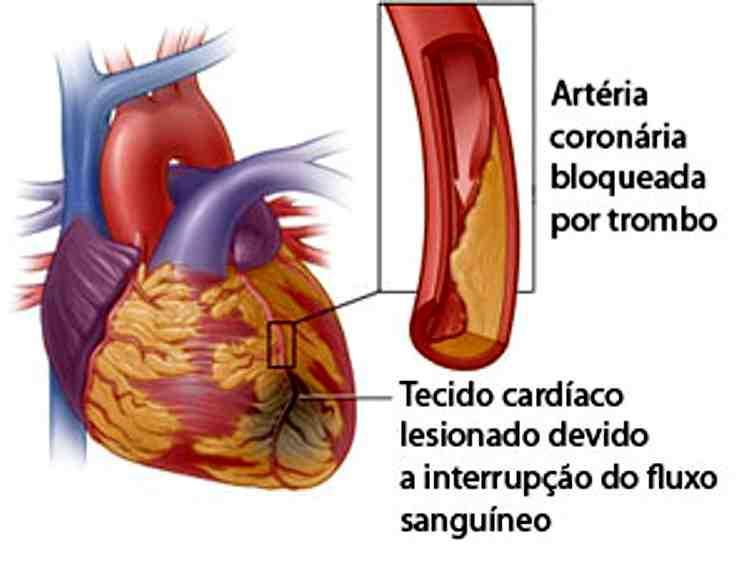 FATOR E MARCADOR DE RISCO A doença arterial coronariana é causada por um crescimento de depósitos gordurosos e ceráceos na parte