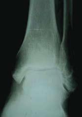 Avaliação etiológica da dor crônica após entorse do tornozelo no momento da avaliação ocorreu entre 4 e 120 meses após o trauma, com um duração total do estudo de oito meses.