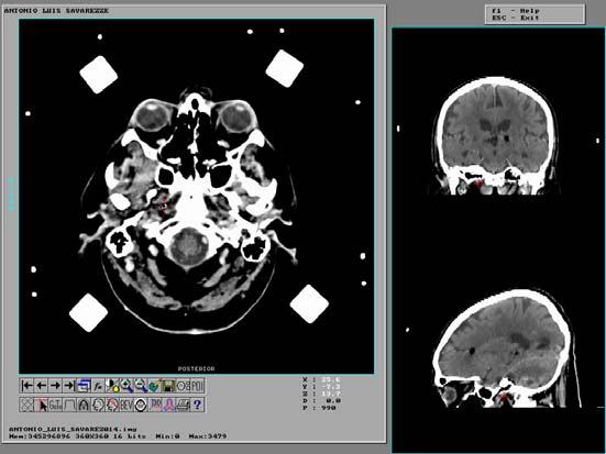 5 mostra as imagens em corte axial e as reconstruções coronal e sagital após o ajuste. FIGURA 5: Imagem de TC após o ajuste da janela de níveis de cinza.