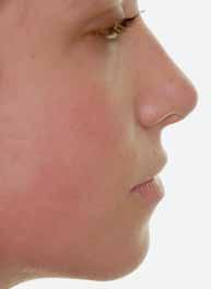 Uma face simétrica mantém o mento centralizado na face, ou seja, colinear com o plano médio sagital. A segunda característica refere-se à proporcionalidade entre os terços faciais.