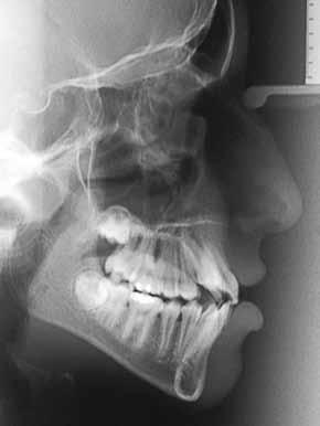 A B FIGURA 3 - Telerradiografias em norma lateral pré-tratamento (A) e pós-tratamento ortodôntico (B) do paciente face longa demonstrando o impacto nulo que a Ortodontia acarreta sobre a morfologia