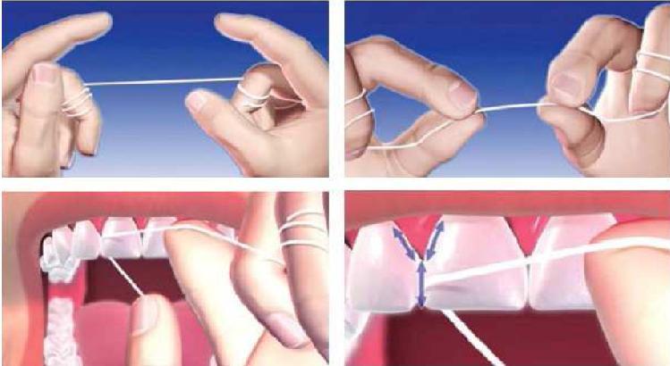 Técnica de uso do fio dental - O fio dental deve ser usado no mínimo duas vezes por dia. - Usa-se o fio dental antes de escovar os dentes. Palito de dente é ajudador ou vilão?